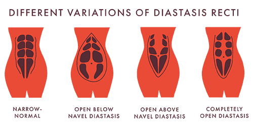 Female Vitality Blueprint diastasis